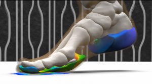 Personalizing Orthopedics for Long-Term Success