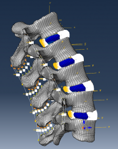 Project of the Year Runner-up: Predicting the Source of Low Back Pain to Inform Personalized Medicine