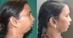LUCID Implants assists surgeons to perform complex facial reconstruction surgery-bilateral TMJ Ankylosis – for a 26-year-old female patient
