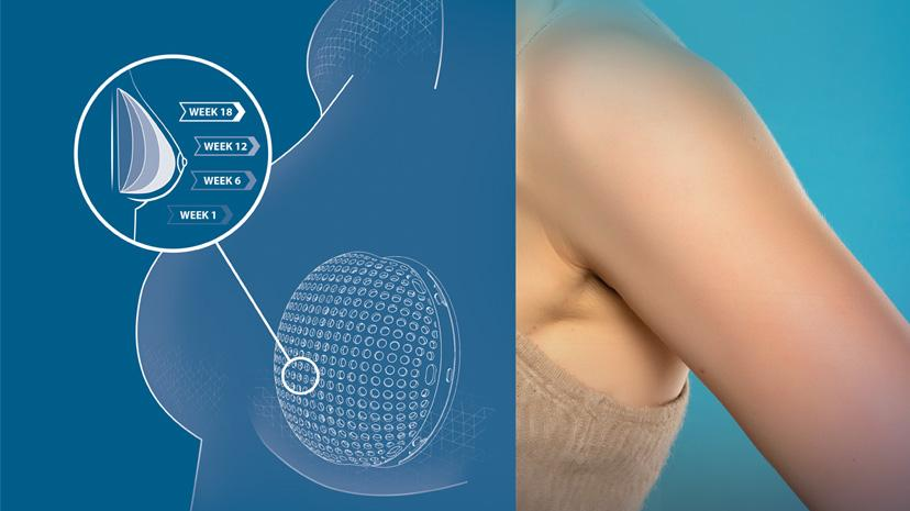 A depiction of Lattice Medica's tissue implant, designed with the 3DEXPERIENCE Lab's technology and platform - Dassault Systemes 